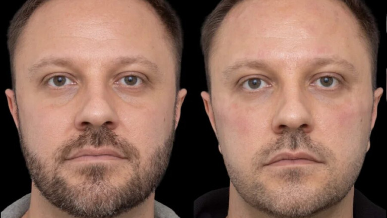 The Best Filler Options for Under Eye Fillers by the Best Doctors in Dubai