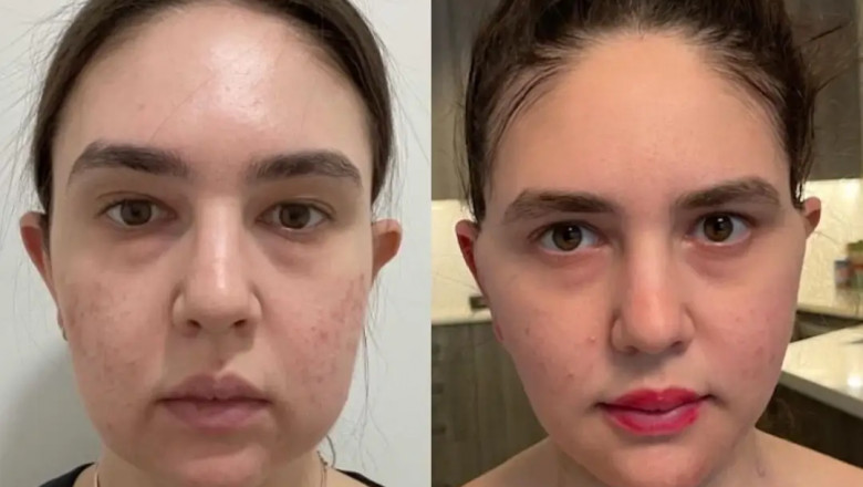 Combining Facelift Surgery with Buccal fat removal in Dubai