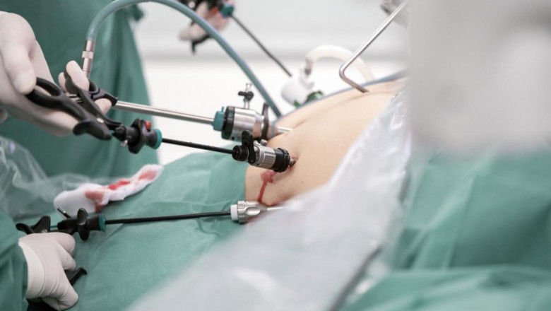 What to Eat After Bariatric Surgery – Stage-by-Stage Guide