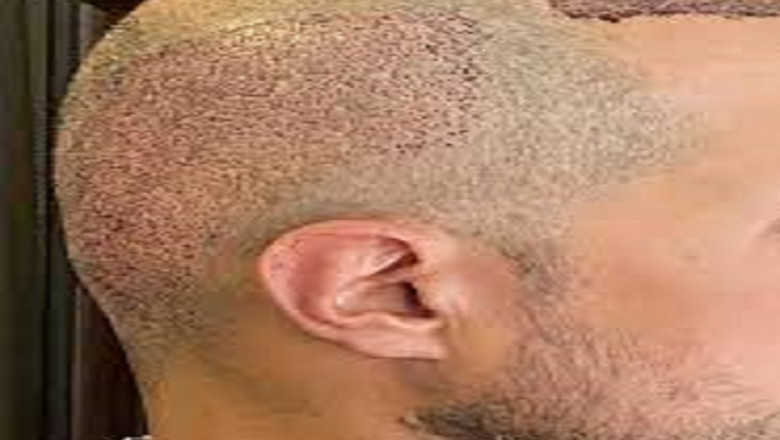 Managing Hair Transplant Recovery in Dubai’s Hot Climate