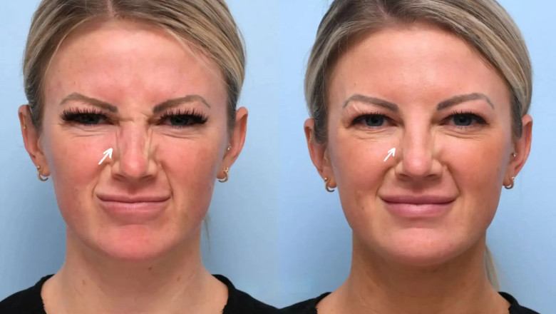 Best Aesthetic Clinic in Dubai: Botox vs. Fillers – Which is Right for You