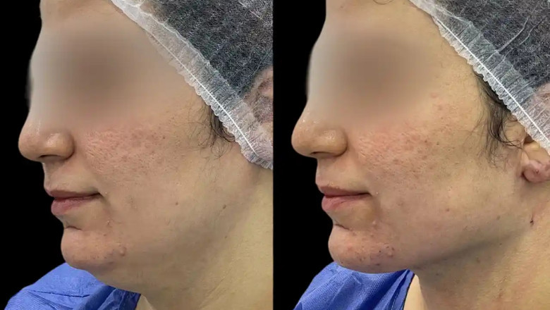 Best Aesthetic Clinic in dubai for Chin Fillers: How to Choose a Qualified Doctor