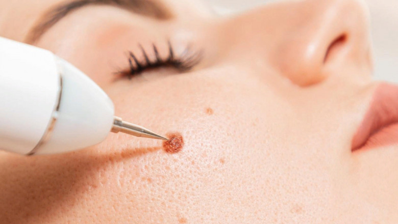 High-Tech Clinics for Wart Removal in Islamabad