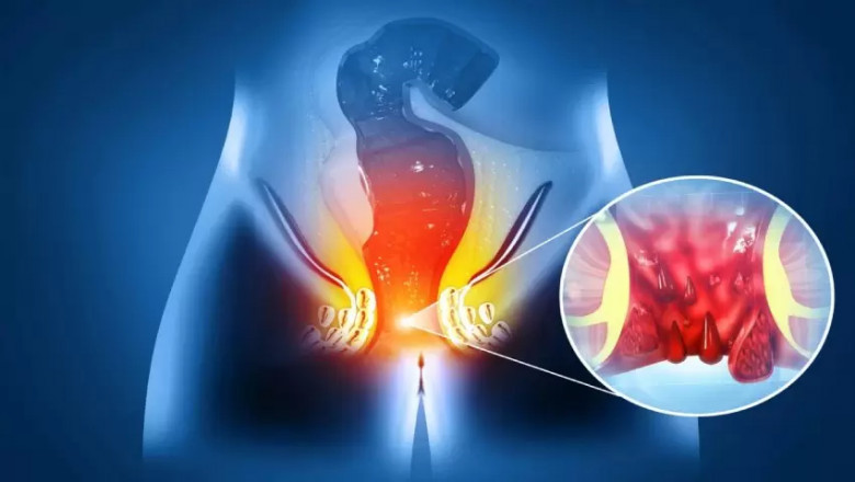 Post-Surgery Care for Anal Fistula: Do’s and Don’ts