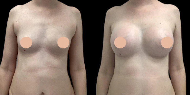 Breast Augmentation in Dubai: What Your Consultation Should Really Cover