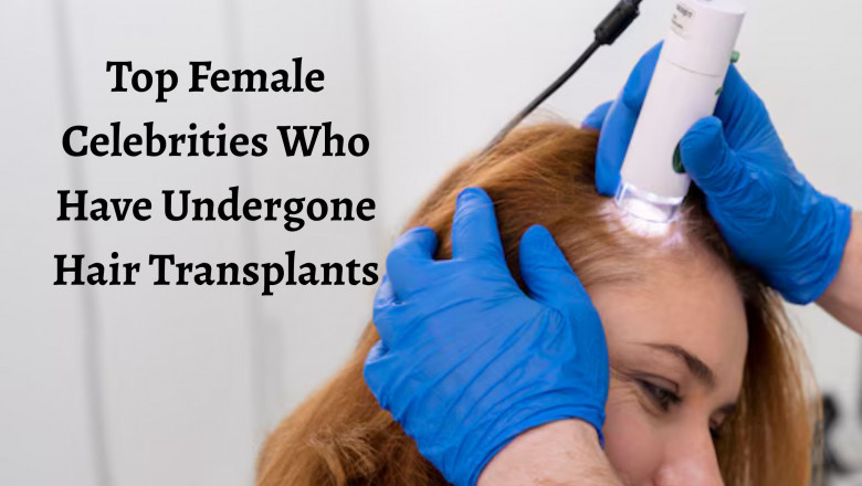 Top Female Celebrities Who Have Undergone Hair Transplants