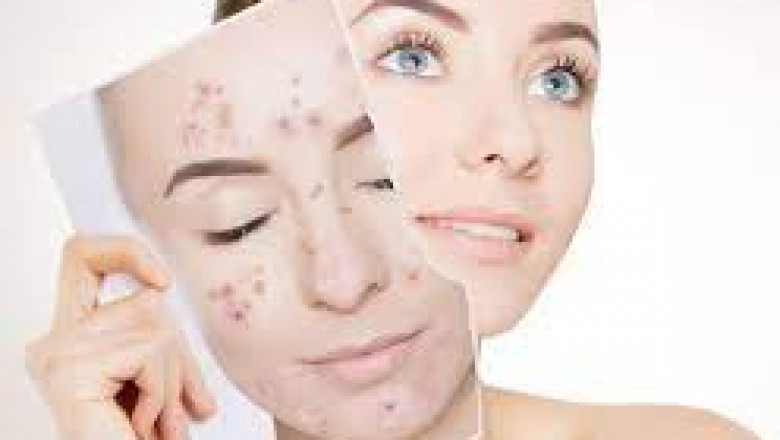 How Isotroin 20mg Works Wonders for Stubborn Acne