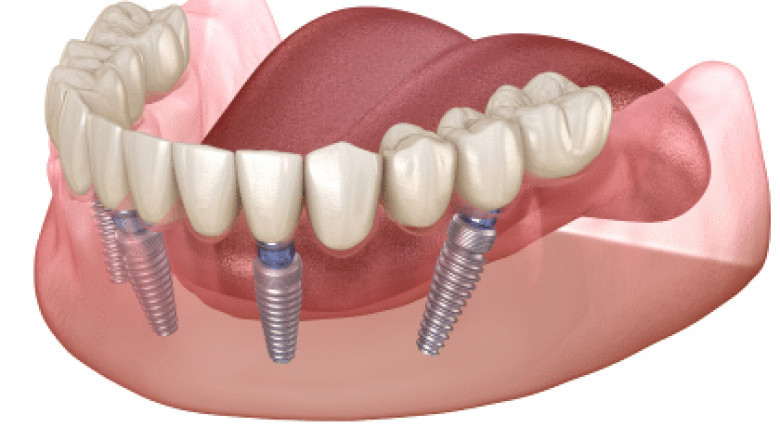 Tips to Prevent Complications After Dental Implant Surgery
