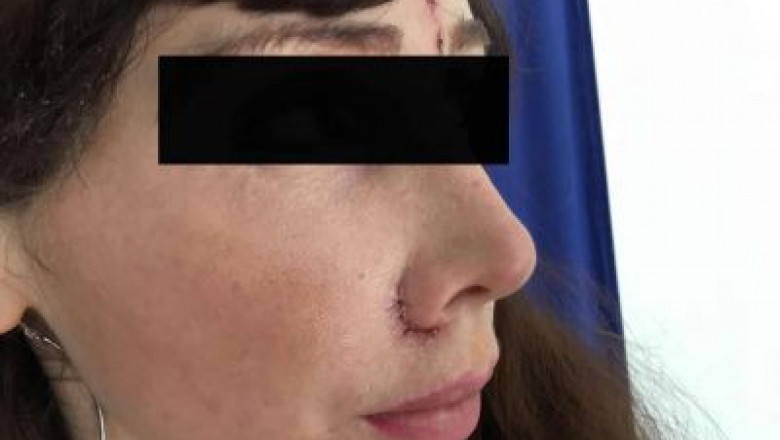 The Subtle Art of the Thread Lift: Rejuvenation Without Surgery’s Rigors