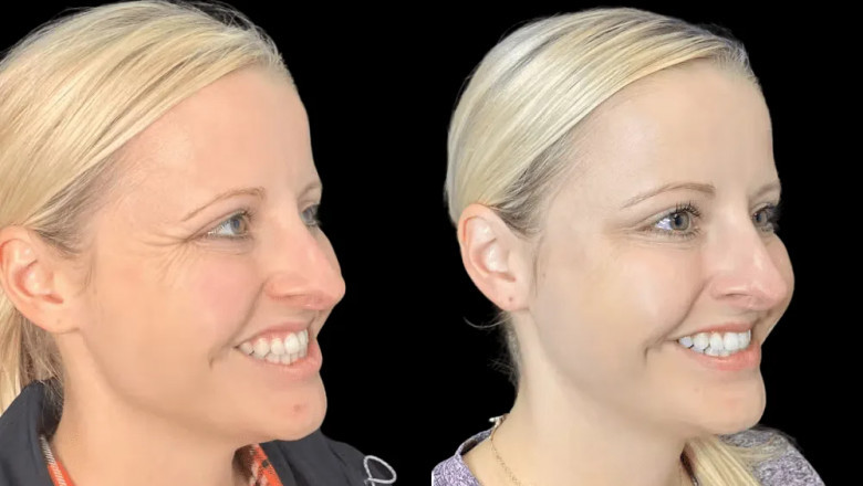 A Step-by-Step Botox Journey at the Best Aesthetic Clinics in dubai