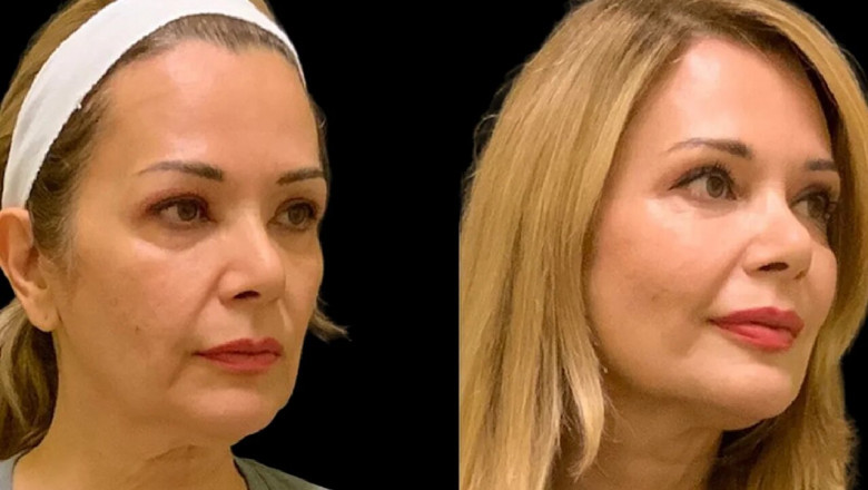 Best Aesthetic Clinics in Dubai: The Best Time to Get Cheek Fillers Injections