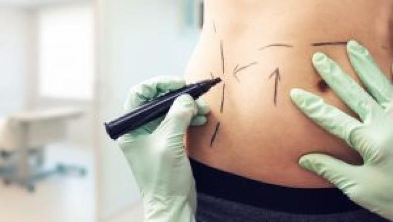 How a Tummy Tuck Can Boost Your Confidence — Dubai Edition