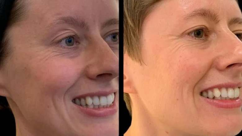 How Profhilo at the Best Aesthetic Clinics in Dubai Can Restore Youthful Radiance
