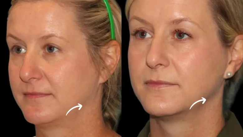 Sculptra Fillers Maintenance Plans at the Best Aesthetic Clinics in Dubai