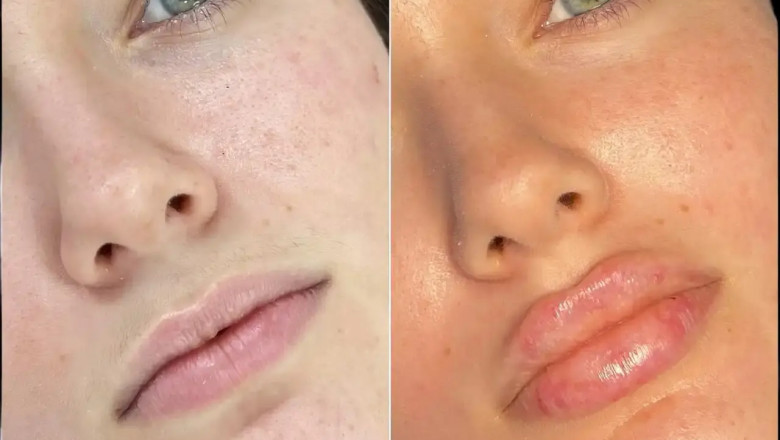 Transform Your Look at the Best Aesthetic Clinics in Dubai for Fillers