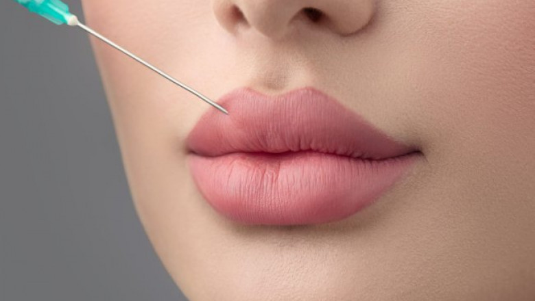 What Are Russian Lip Fillers in Dubai and Why Are They So Popular?