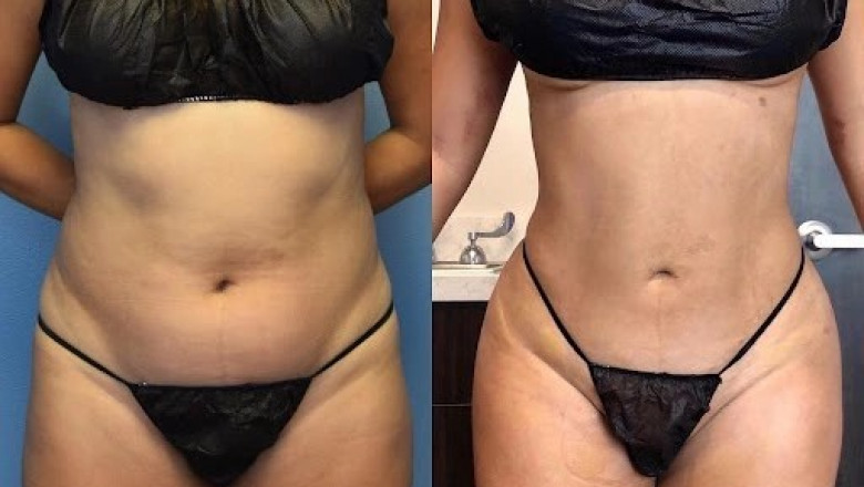 The Life-Changing Benefits of Full Body Liposuction Surgery in Dubai