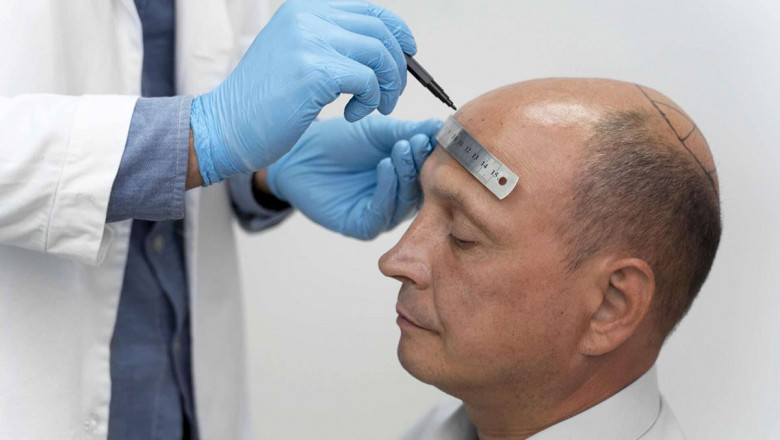 زراعة الشعر في دبي – الحل الدائم للصلع واستعادة الثقة