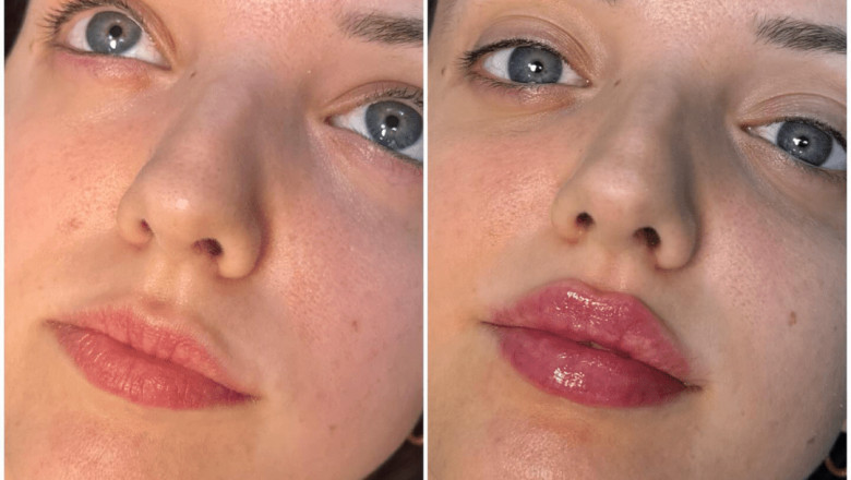 How Juvederm Helps You Achieve Fuller, Lush Lips: Expert Advice from the Best Plastic Surgeon in dubai