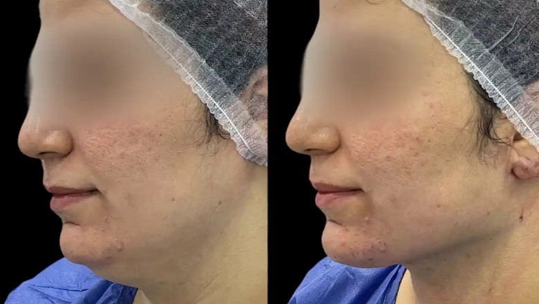 How to Prepare for Your Chin Fillers Treatment in Dubai