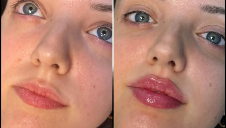 Restoring Fullness to Your Skin with Fillers Treatment in Dubai