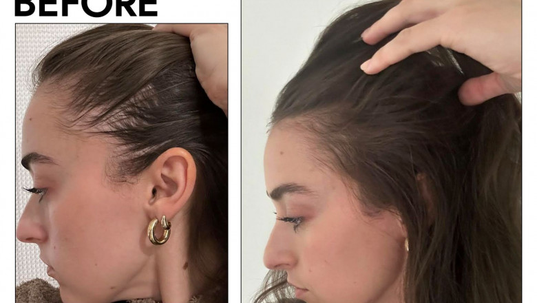 Effective Hair Fall Treatment in Chennai at DC Skin Health