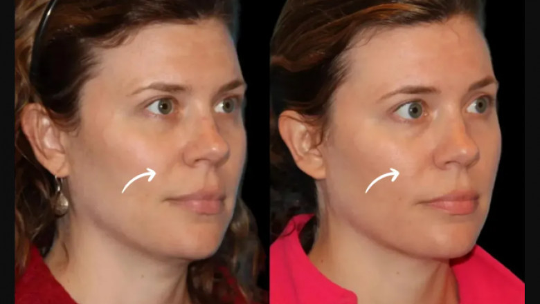 Customizing Sculptra Fillers for Each Face: Best Doctors in Dubai Explain