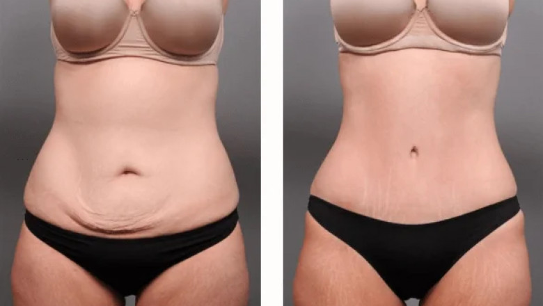 Fat Transfer in Dubai Success Stories: Real Patient Experiences and Transformations