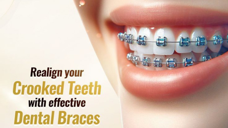 Achieve the Perfect Smile with Dental Braces in Islamabad