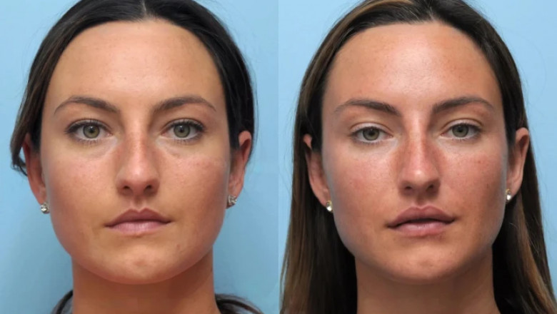 Explore the Skills of the Best Doctors in Dubai for Thread Lift