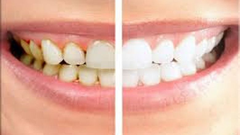 How to Care for Your Veneers in Dubai to Maintain a Bright Smile