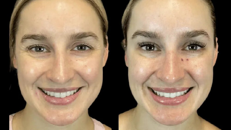 Natural Beauty Redefined: Botox by the Best Doctors in dubai