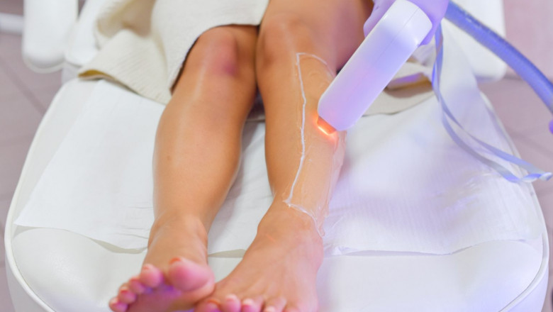 Understanding the Longevity of Laser Hair Removal Results in Gurgaon