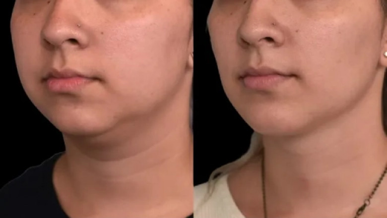 Achieve a Sculpted Jawline with Double Chin Removal by the Best Doctors in Dubai