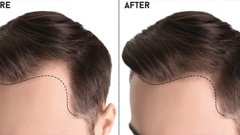 Choosing Excellence: A Comprehensive Guide to the Best Hair Transplant in Pakistan"
