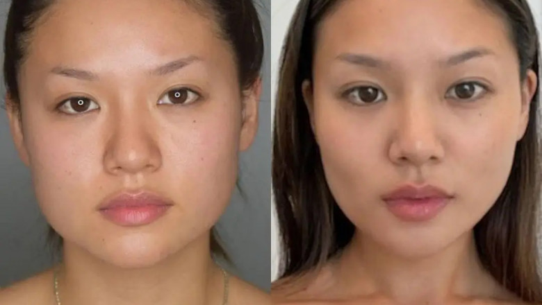 Does Buccal Fat Removal Affect Smile and Speech? Best Doctors in Dubai Explain