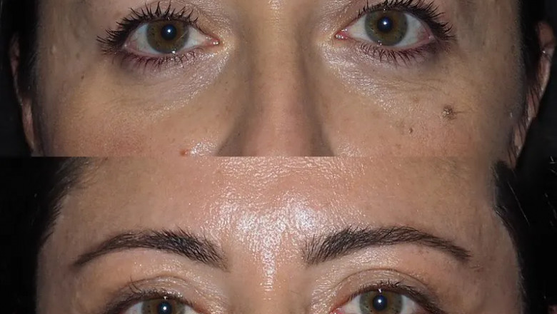 Eye Bag Removal Recovery Tips from the Best Doctors in Dubai