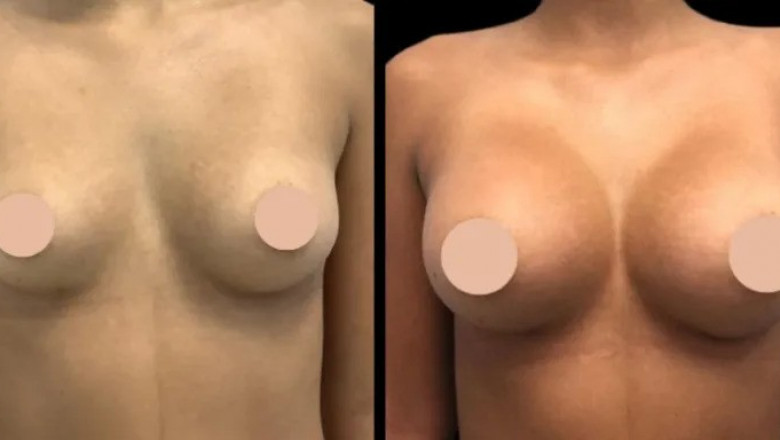 How to Maintain Breast Enhancement Results: Insights from the Best Doctors in Dubai