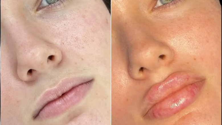 Best Plastic Surgeon in Dubai for Fillers: Dubai's Elite Injectors