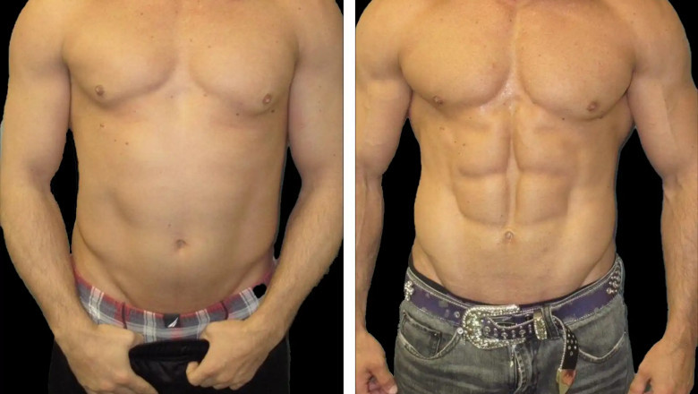 Breaking the Myths What Men Should Know About Full-Body Liposuction in Dubai
