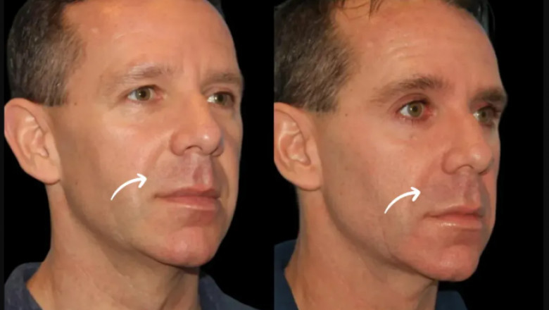 Choosing Between Fillers: Why the Best Plastic Surgeon in Dubai Favors Sculptra Fillers