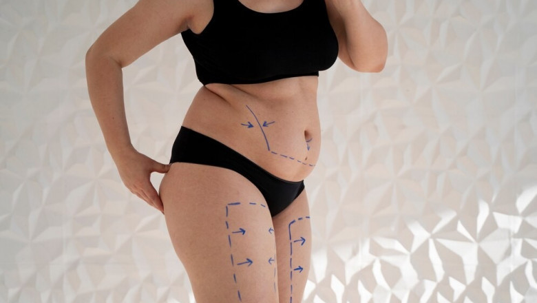 How Fat Transfer in Dubai Helps Achieve Natural and Long-Lasting Results