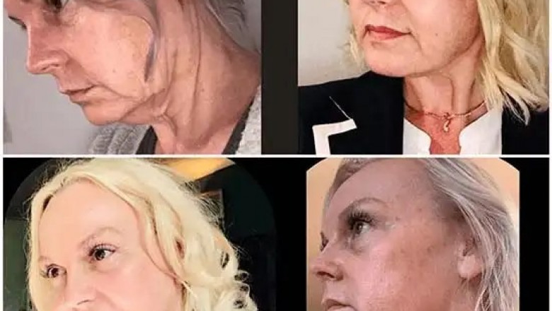 Energize Face via Profhilo Treatment in Dubai