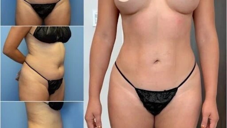 Get the Perfect Contours with Body Contouring in Dubai