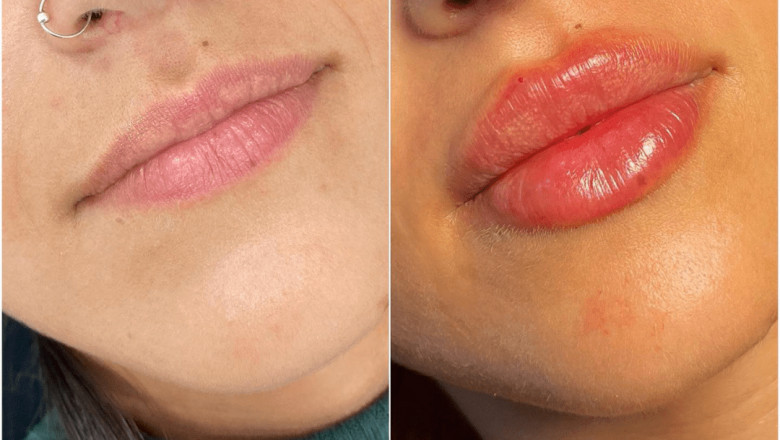 Pairing Botox with Juvederm treatment in Dubai