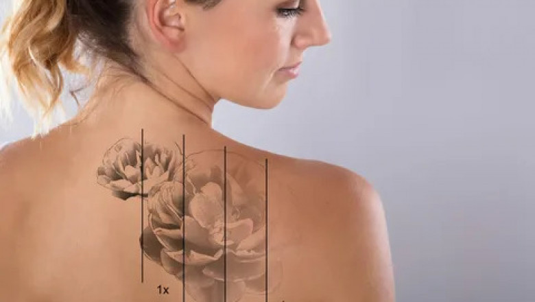 Top Discounts on Laser Tattoo Removal in Islamabad This Month