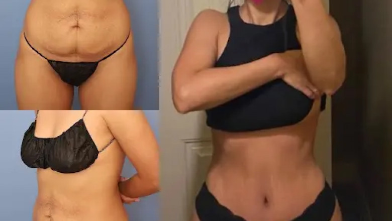 Tummy Tuck in Dubai: Preparing Your Body for Surgery