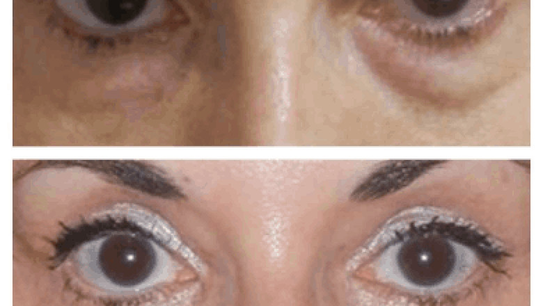 Are There Any Non-Invasive Alternatives to Eye bag removal Surgery in dubai?