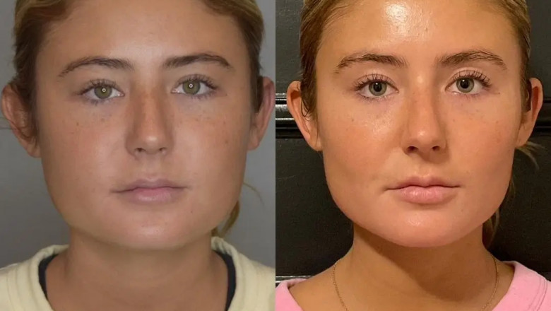 Buccal fat removal Surgery in dubai for Men: What You Need to Know