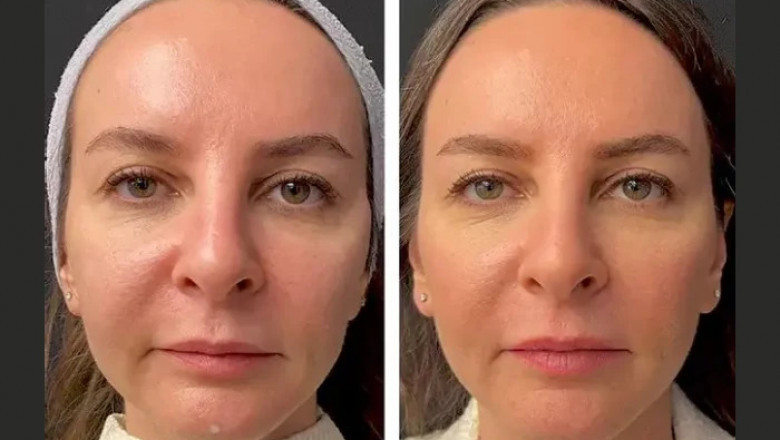 Comparing Mesotherapy Treatments in Dubai with Other Aesthetic Procedures